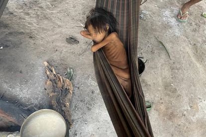 Uma menina Yanomami sofrendo de desnutrição e malária em Maimasi, Brasil.
