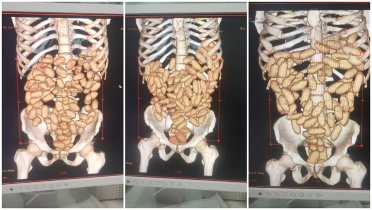 Imagens de exames de raio-x que mostram cápsulas com cocaína dentro dos estômagos de estrangeiros.